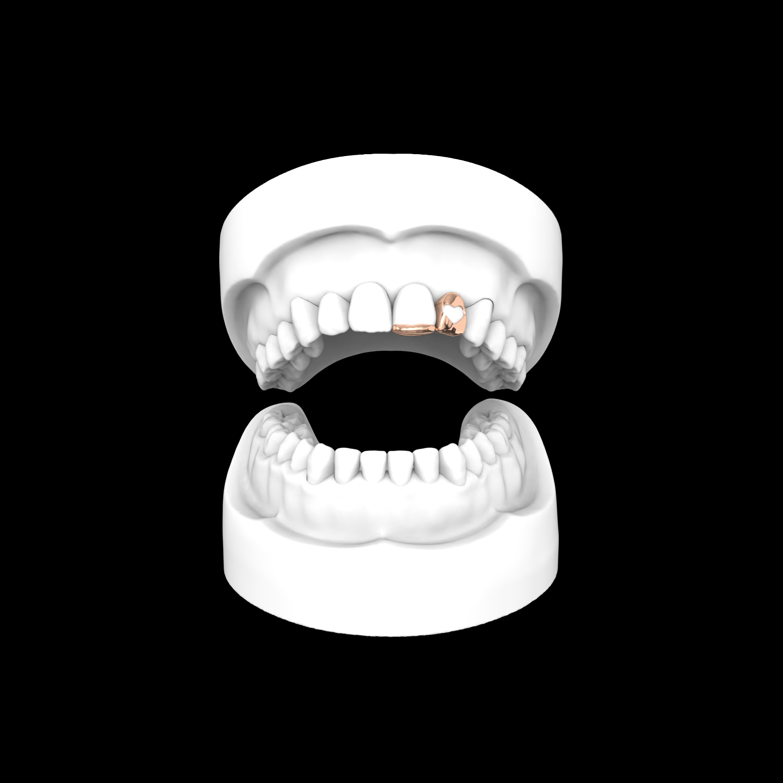 Inlay + Open Face Heart